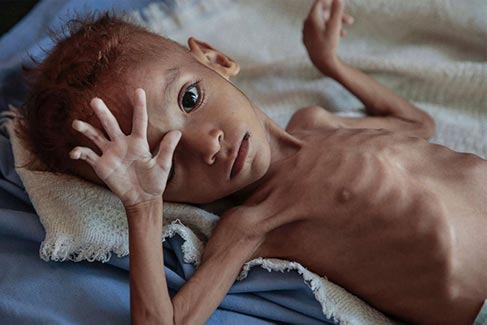 yemen malnourished child
